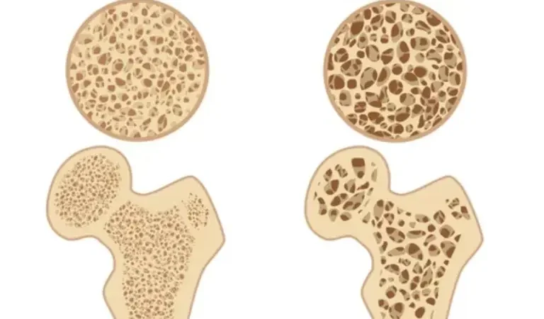 Osteoporosis: Hacia el 2050, se espera que el 37% de los mexicanos mayores de 50 años la padezca