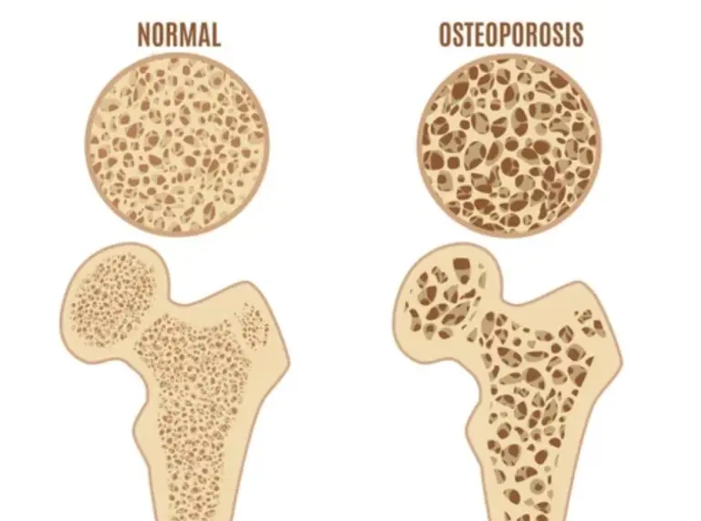 Osteoporosis: Hacia el 2050, se espera que el 37% de los mexicanos mayores de 50 años la padezca