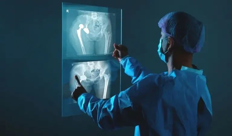 La fractura de cadera, un desafío en el envejecimiento saludable